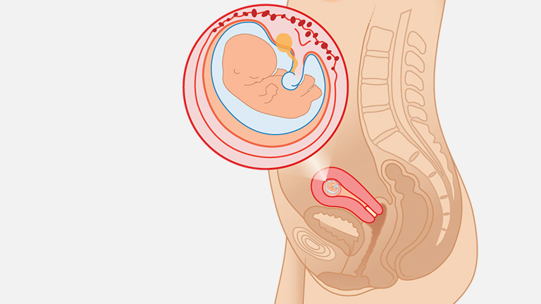 Thai tuần thứ 9: Dấu hiệu mang thai sớm là gì?